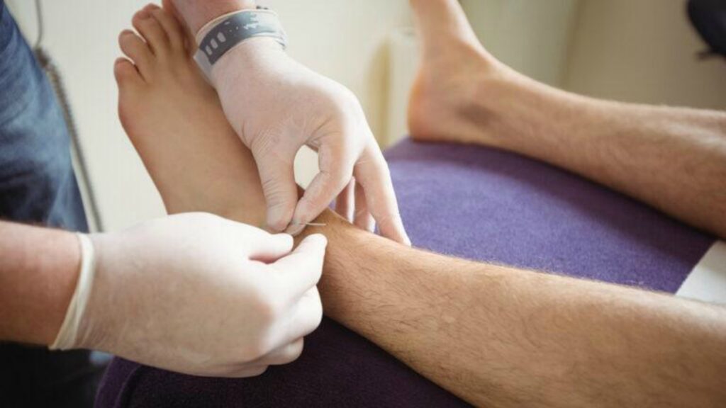 Punción seca, una alternativa de la Fisioterapia