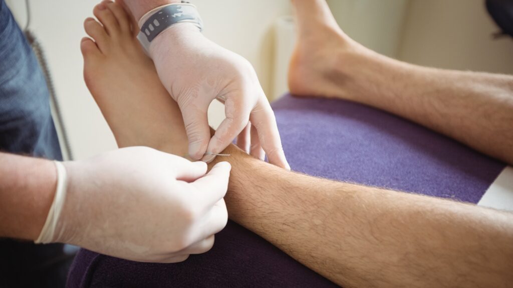 Punción seca, una alternativa de la Fisioterapia