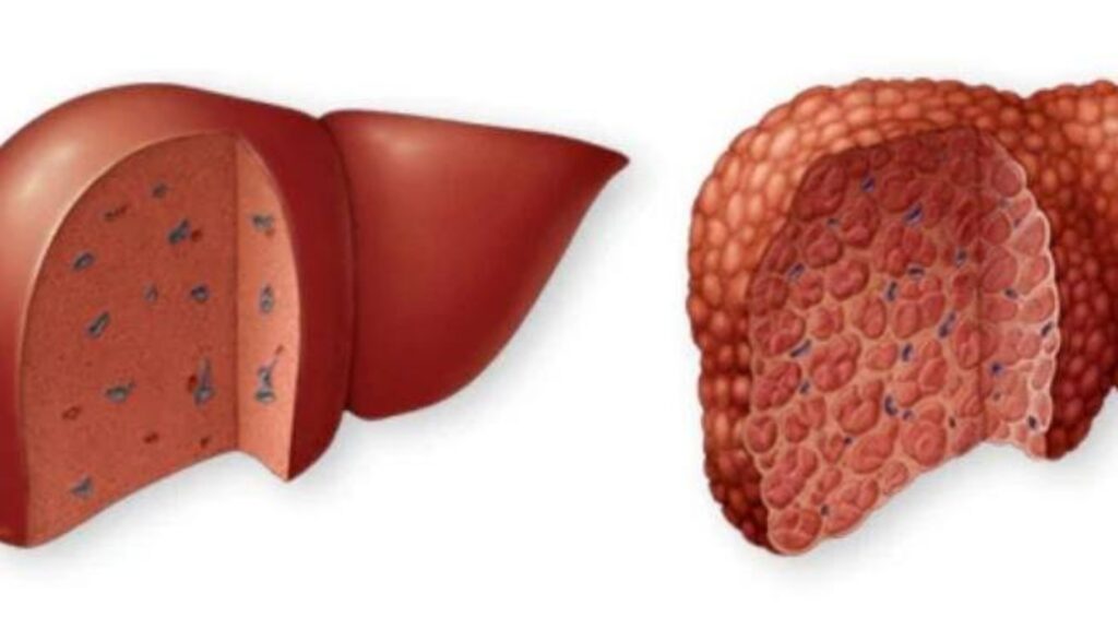 Mayo Clinic da a conocer nuevos resultados sobre pacientes con cirrosis