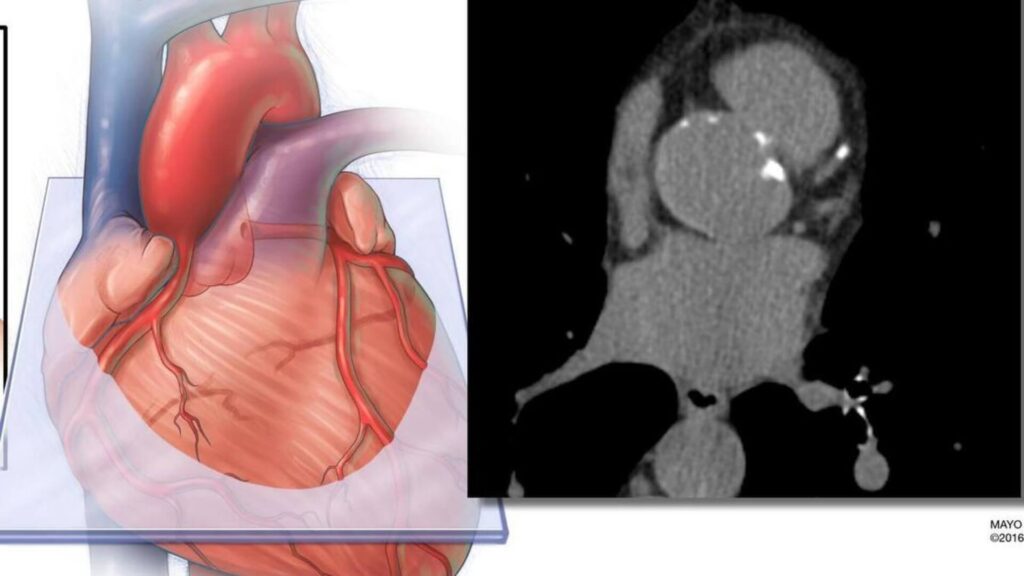 IA mejora la predicción del riesgo cardiovascular con medición de grasa cardíaca