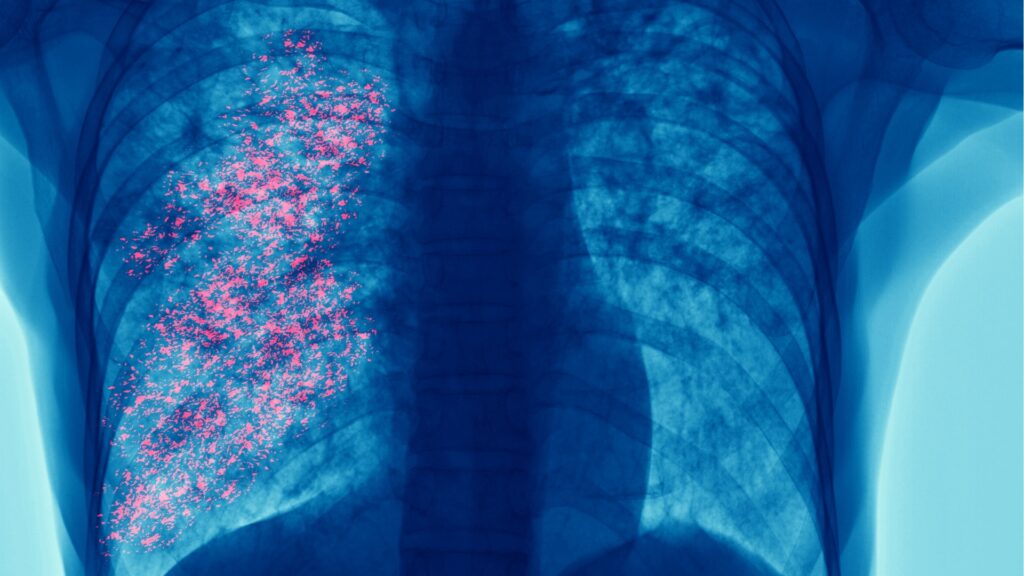 Cáncer de pulmón: la detección temprana es clave para mejorar el pronóstico